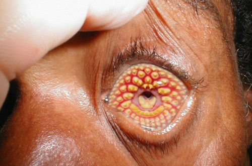 20 Of The Weirdest And Rarest Diseases Known To Mankind