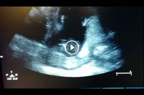 Ultrasound Shows Unborn Baby Clapping Hands
