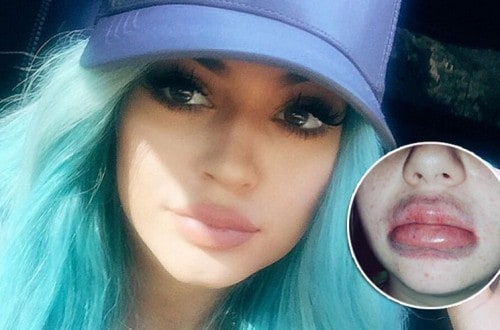 20 Reasons Why You Shouldn’t Try The Kylie Jenner Lip Challenge