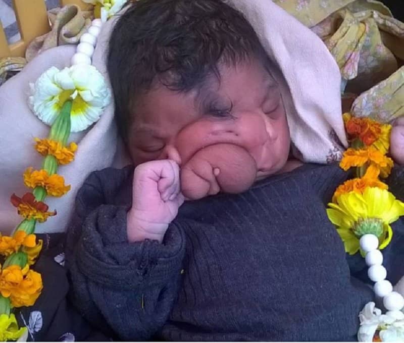 Indian Girl Born With Trunk Is Worshiped As Hindu God