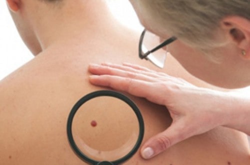 Researchers May Have Found A Cure For Melanoma