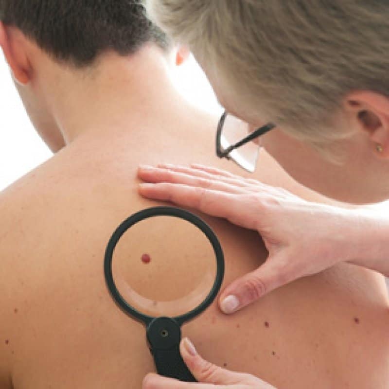 Researchers May Have Found A Cure For Melanoma