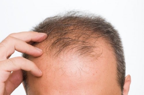Clever Hair Loss Remedy Uses Dietary Reversal Agents to “Turn Back the Clock” on Men’s Hairlines