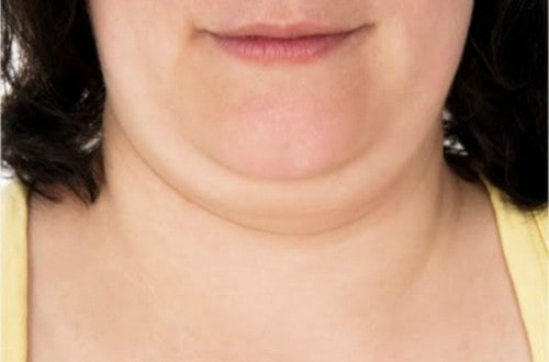 New Injection Promises To Dissolve Your Double Chin