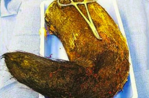 20 Crazy Things Doctors Have Found Inside People’s Bodies