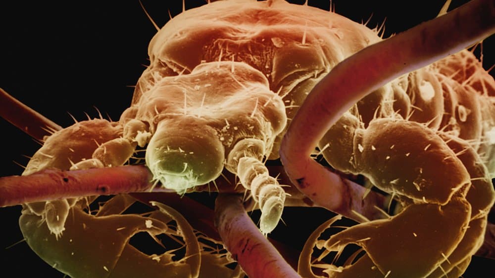 Lice Found Living In Woman’s Eye