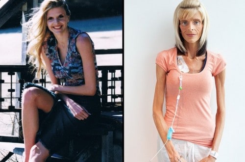 Ex-Model Lisa Brown Starving To Death Due To Rare Disease