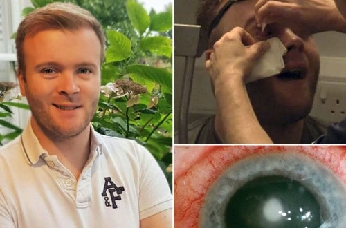 Ulcer Forms On Cornea After Man Leaves Contact Lens In Overnight