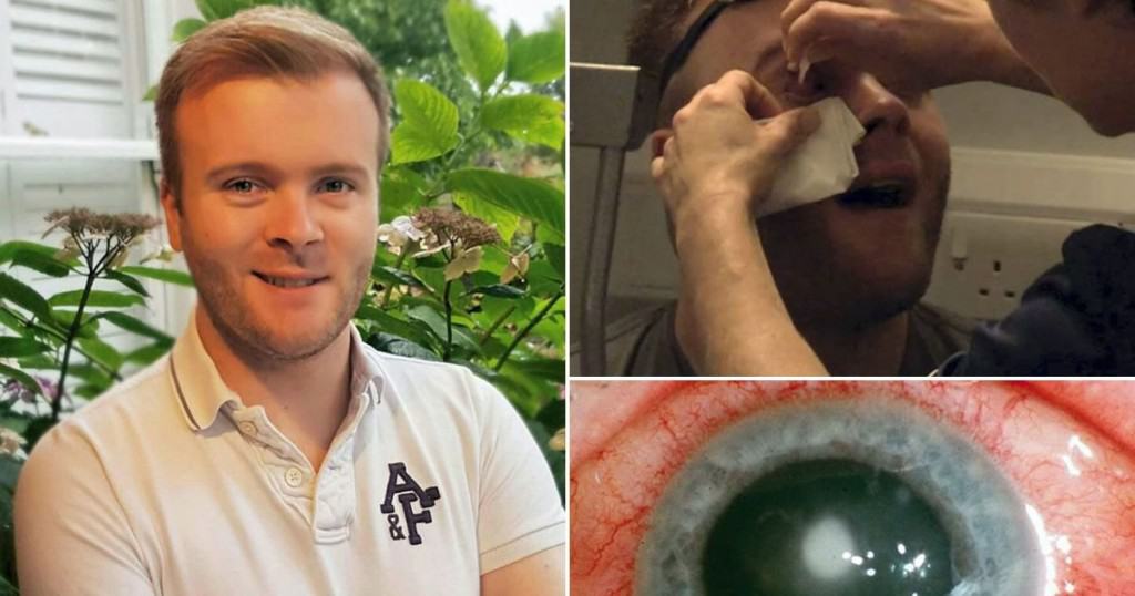 Ulcer Forms On Cornea After Man Leaves Contact Lens In Overnight