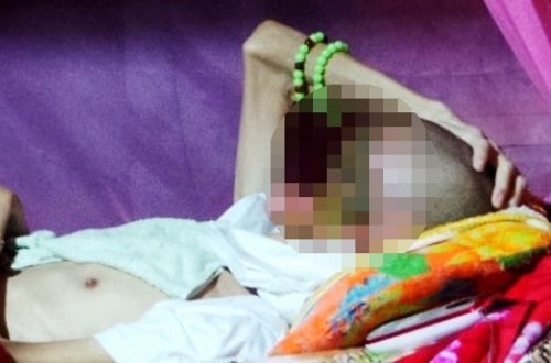 Flesh Eating Disease Ravages A Vietnamese Man