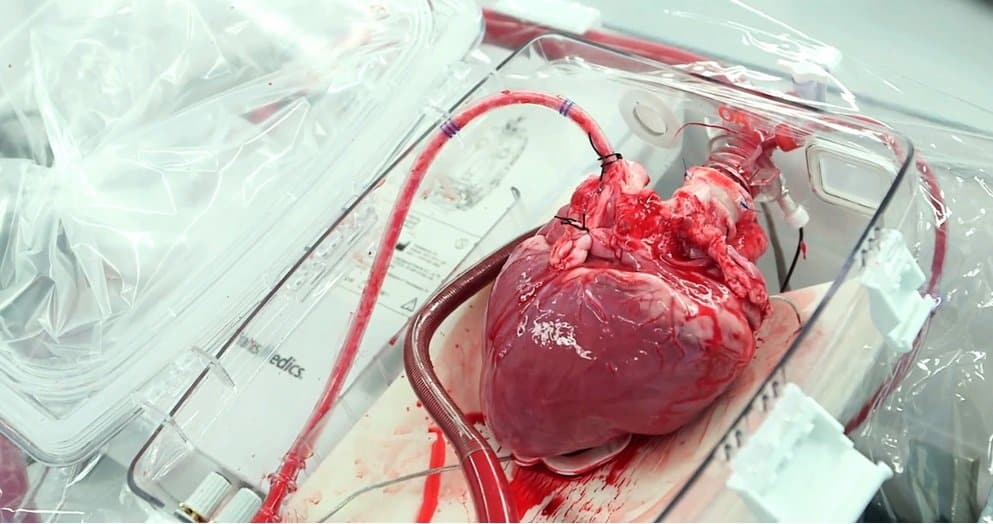 Man Receives A Revolutionary Heart Transplant