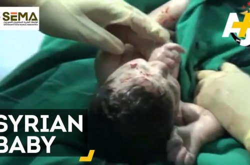 Shocking Birth Of Syrian Baby With Shrapnel On Forehead