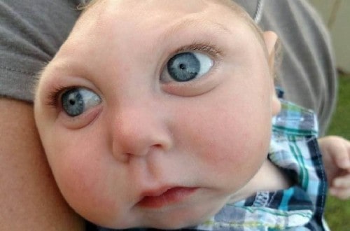 This Baby Was Born Without Most Of His Brain And Is Doing Things Doctors Never Thought He Would