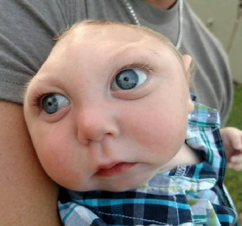 This Baby Was Born Without Most Of His Brain And Is Doing Things Doctors Never Thought He Would