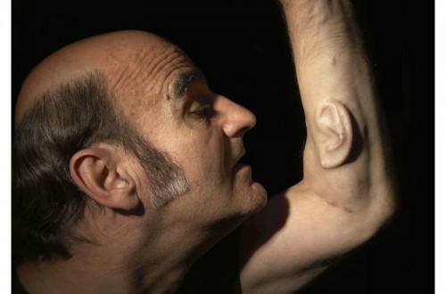 This Man Is Growing A Third Ear From His Arm, You Won’t Believe Why