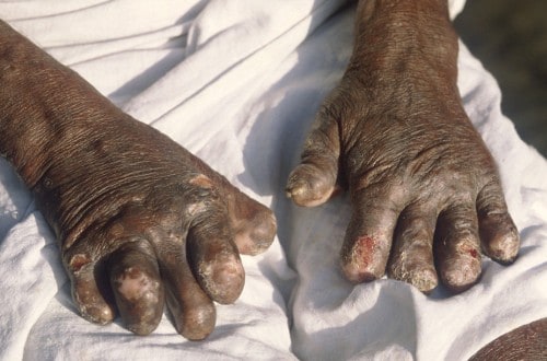 10 Of The Deadliest Diseases Afflicting Mankind