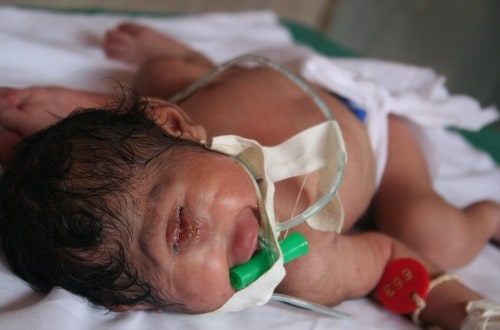 Baby Born With Only One Eye Lives Just A Few Days