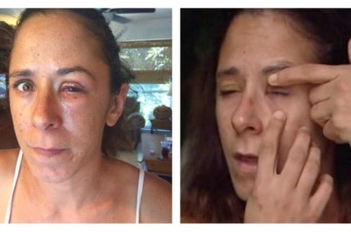 Woman Accidentally Super Glues Her Eye Shut