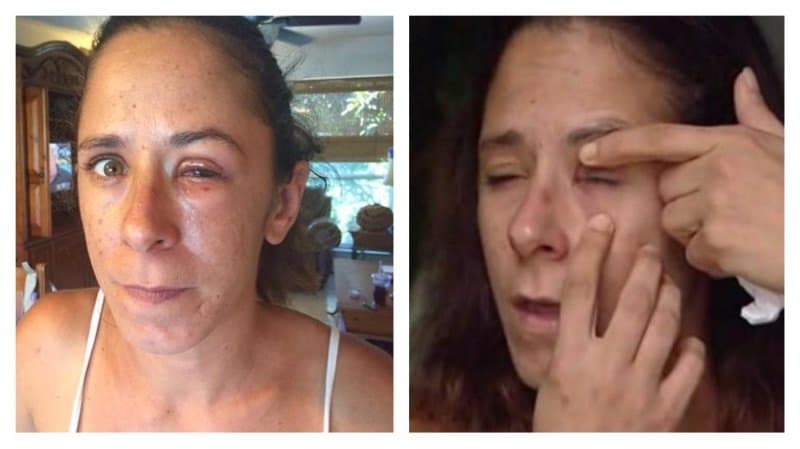 Woman Accidentally Super Glues Her Eye Shut