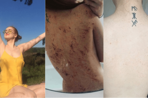 Woman’s Eczema ‘Cured’ By Going Vegan