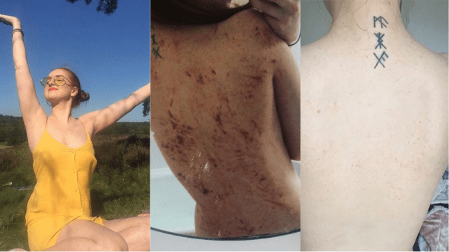 Woman’s Eczema ‘Cured’ By Going Vegan
