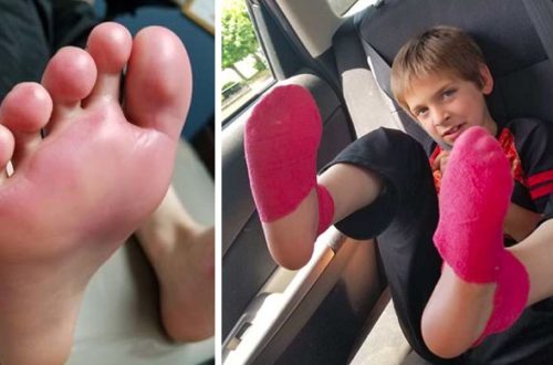 Sneakers Cause 9-Year-Old To Get 2nd Degree Chemical Burns