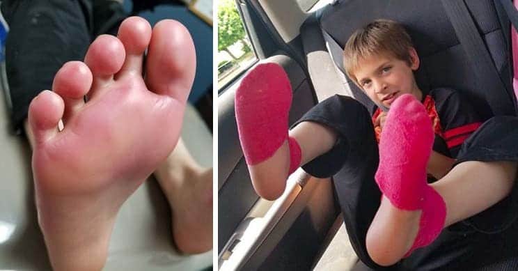 Sneakers Cause 9-Year-Old To Get 2nd Degree Chemical Burns